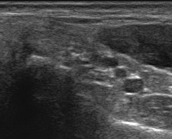 $$ # # Behind the medial malleolus, place the transducer over the short-axis of the tibialis posterior and the flexor digitorum longus tendons.
