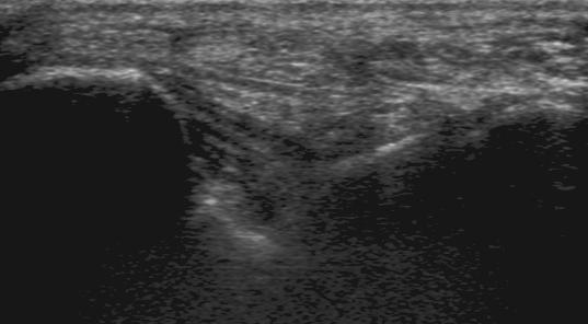 Follow this tendon on short-axis plane as it passes under the sustentaculum tali and crosses the flexor digitorum longus.