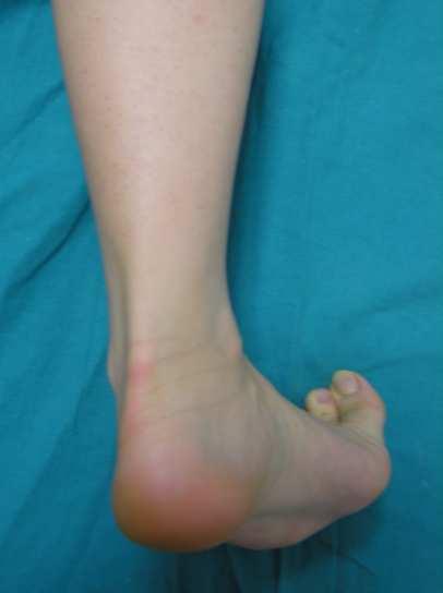 portion of the flexor hallucis longus in its longaxis and the posterior recesses of the tibiotalar and subtalar joints.