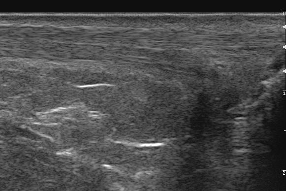 Achilles tendon full-thickness tear.