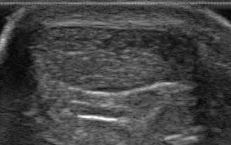 peritendinous envelope. Measure the size of the Achilles tendon only on transverse planes.