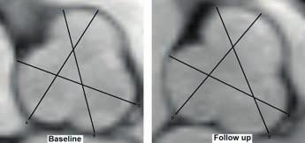 106 Chapter 5 figure 3 MR Images Showing the Aortic Root in Short Axis of a COMPARE Patient with Marfan at Baseline and after 3 Years of Follow-up Greatest aortic root diameter of 3 measured