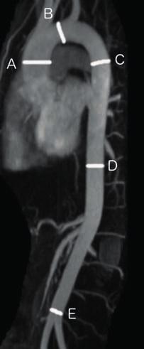 A = Ascending aorta B = Arch of the aorta C = Descending aorta D = Aorta at level of the diaphragm E = Abdominal aorta 3 figure 2b MR image showing an aortic root in the short axis of a patient with