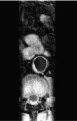 2 Atherosclerosis Imaging Imaging subclinical atherosclerosis has clinical benefits in general and in familial hypercholesterolemia (FH) 1-3 Currently,