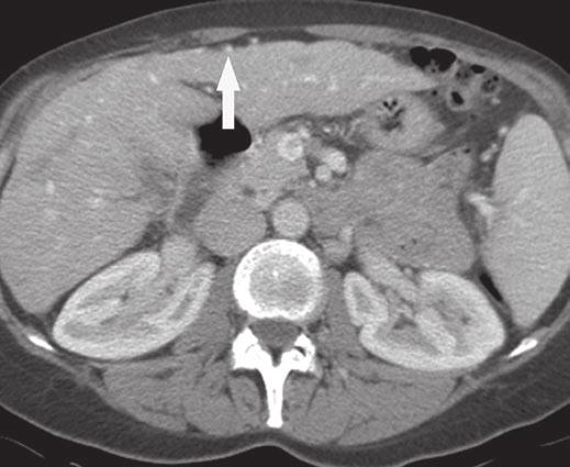 Jha et al. Fig. 1 62-year-old woman with breast cancer treated with chemotherapy.