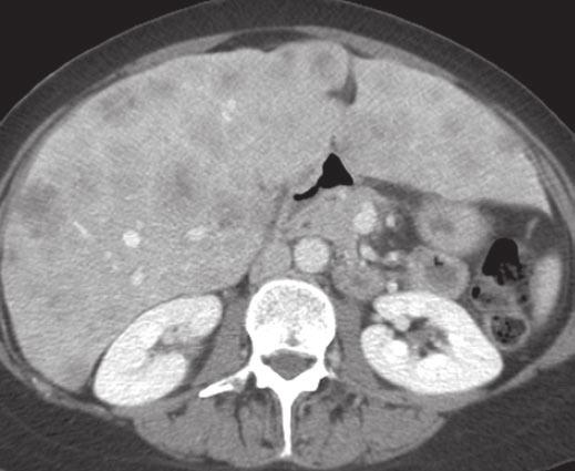 vein (arrow); these findings are suggestive of cirrhosis.