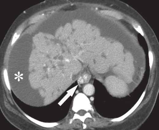 treated breast cancer. Fig. 2 59-year-old woman with multiple hypodense biopsy-proven hepatic metastases from invasive ductal carcinoma of breast.