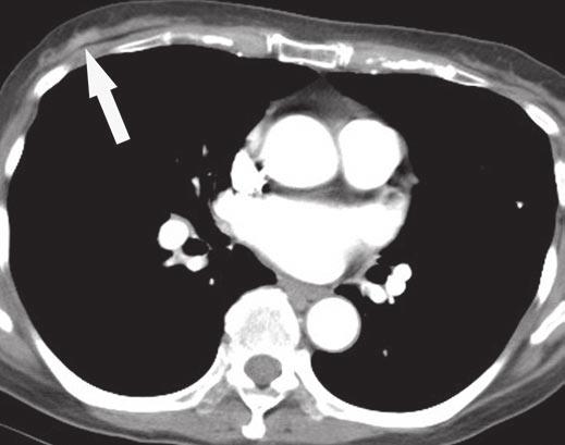 , xial contrast-enhanced CT image shows liver surface is coarsely lobulated with several irregular hypodense parenchymal lesions.