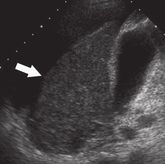 Histopathologic examination of explanted liver 5 days later showed confluent regenerative nodules surrounded by large areas of necrosis, but no cirrhosis.