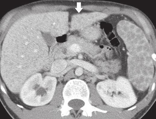 ppearance of liver on CT alone could be interpreted as cirrhosis, but note multiple hypodense nodules in spleen.