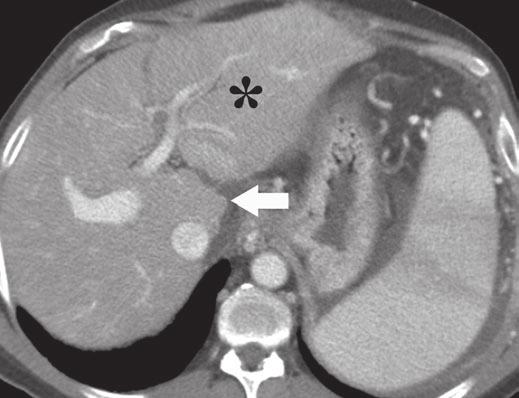 Radiologic Mimics of Cirrhosis Fig. 10 58-year-old man with history of renal transplantation for HIV nephropathy who presented with sepsis 1 day after right hemicolectomy for colonic volvulus.