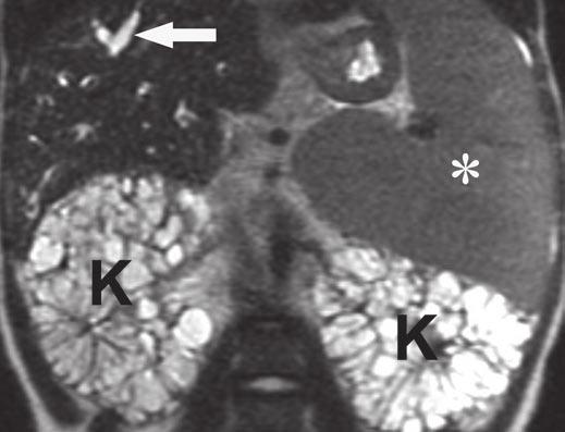 , xial contrast-enhanced CT image shows subtle parenchymal heterogeneity consisting of small hypodense nodules. Representative nodule (arrow) is visible posteriorly.