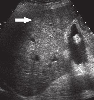 11 60-year-old man with portal hypertension leading to gastrointestinal bleeding, ascites, and thrombocytopenia due to biopsy-proven nodular regenerative hyperplasia in liver transplant;
