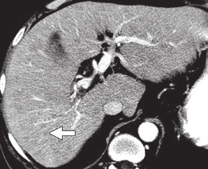 xial contrast-enhanced CT image shows liver surface (arrow) is irregular and shows relative hypertrophy of left hepatic lobe (asterisk). These findings mimic those of cirrhosis. Fig.