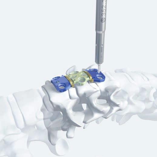 Implant Selection and Preparation 3 Secure plate with Fixation Pins Required Instruments 324.101(S) Fixation Pin for temporary use, (sterile) 324.