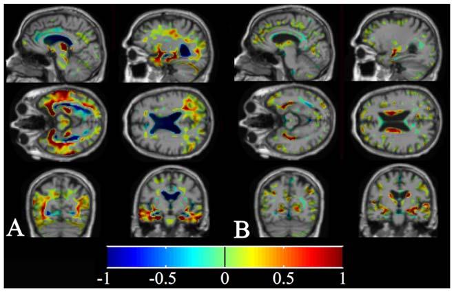a well validated biomarker for AD, referred to as Hippocampal volumetry.
