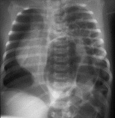 Chest X-Ray 43 44 Mortality is very high Immediately upon diagnosis Rates Hypoplastic lung Is very stiff & susceptible to barotrauma 45