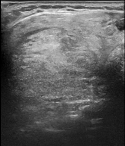 Post-RFA B-mode scan of the right lobe of the thyroid showing the