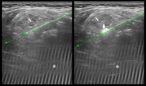 Virtually-guided RFA Procedure In-plane approach showing the expected needle path: two consecutive scans.