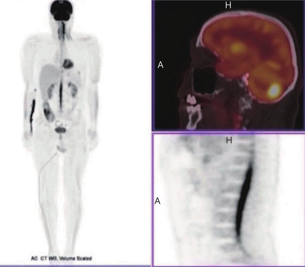 Cancer Biol Med Vol 13, No 4 December 2016 515 administered with subsequent computer tomography scanning to determine the response (Figure 6).