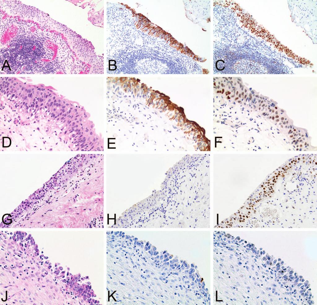 Challenging scenarios with cytokeratin 20 (CK20) and p53 immunohistochemical staining in urothelial atypia.