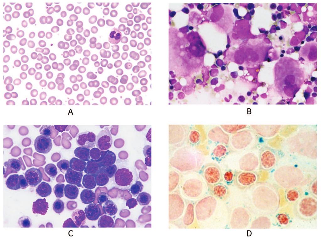 Pathologic features of MDS/MPN RARS- T Peripheral blood: Increased platelets & dysplas>c neutrophil BM aspirate: increased clustered megas BM aspirate: dysplas>c Red