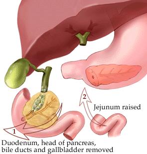 What are the treatment options? (continued) Whipple s operation (also known as a pancreaticoduodenectomy). This is the most common surgery for cancer of the head of the pancreas.