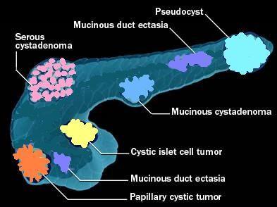 What are cystic tumours of the pancreas? Cystic tumours of the pancreas refer to growths which have fluid within them produced by the lining of the tumour.
