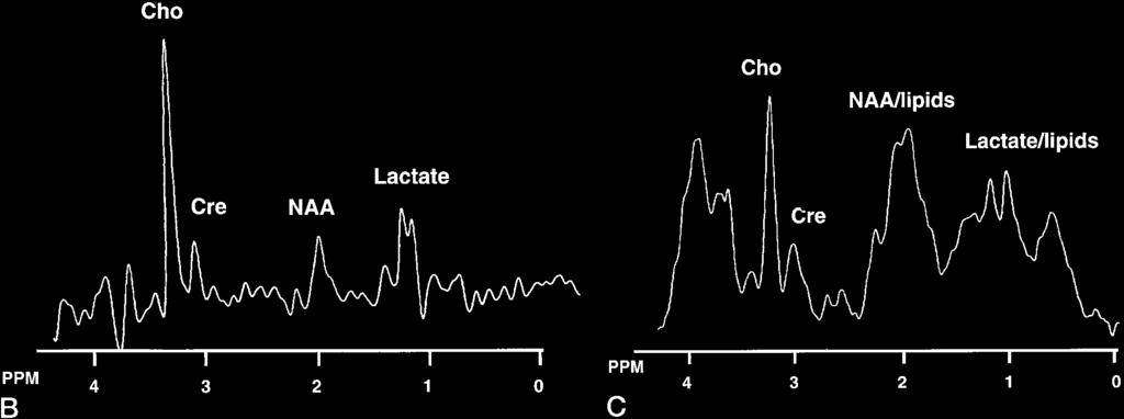 B, Proton spectrum from PRESS sequence (2000/270) in pediatric pilocytic astrocytoma. Decreased NAA (2.0 ppm) and Cr (3.0 ppm) were observed, and lactate (1.33 ppm) and Cho (3.2 ppm) are prominent.