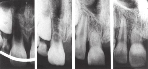 Ingrowth of cementum, PDL, and bone into the pulp space This phenomenon has been known for some time to occur after dental trauma (48, 49) (Fig. 3).