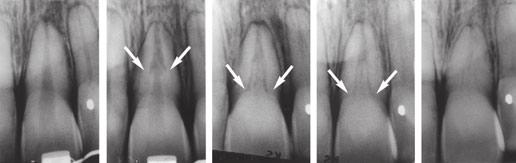 Pulp regeneration - type of tissue 5 Fig. 6. Internal tunneling resorption parallel to the root canal developed after extrusion of a central maxillary incisor.
