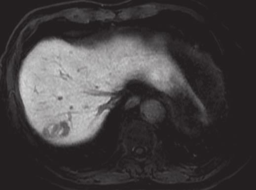 Liver Abscess After Transarterial Chemoembolization A C E Fig.