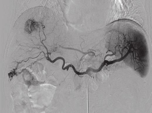 B, Celiac angiogram shows mass with hypervascular tumor staining.