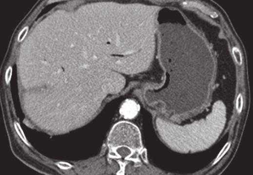 D, CT image obtained 12 days after TACE shows large liver abscess adjacent to mass compacted with