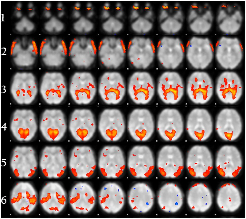 A Classifier to Distinguish fmri Noise Components Figure 3. Component types.
