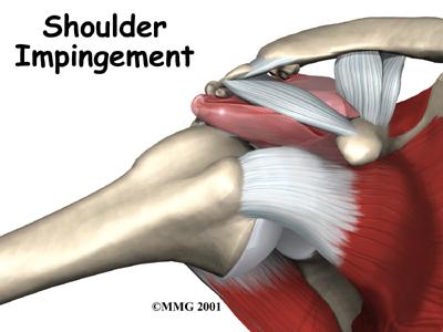 Shoulder Impingement Might be a derangement Might be a contractile dysfunction MIGHT BE BOTH!