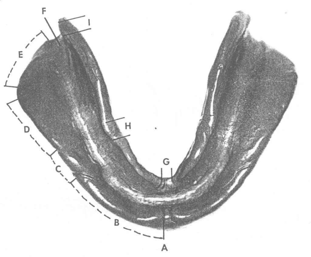 created where the convex curvature of the mylohyoid ridge meets the concave curvature of the mandible.