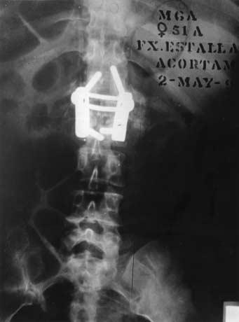 11 Fig. 5 Normal alignment on anteroposterior plain radiograph Fig.