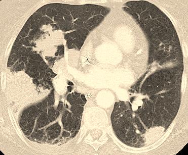 AJR 2005; 185:622-626. Dewar GJ et al. : An emerging cause of pulmonary nodules. Can Respir J 2008; 15:153-158.
