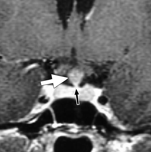 Salt Lake City, UT: mirsys, 2002 [16]), Sagittal contrast-enhanced T1-weighted image of infundibular adenoma shows that, superiorly,