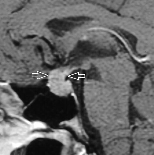 , Coronal contrast-enhanced T1-weighted image shows prolactinoma (white arrow) arising from stalk (black arrow). Fig.