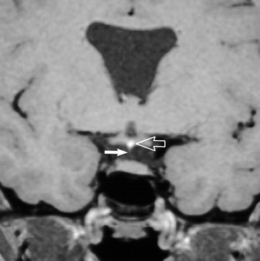 Pituitary gland and sella turcica are small. Note ectopic neurohypophyseal T1 hyperintensity (open arrow).