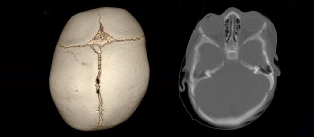 Positional Plagiocephaly is different than craniosynostosis.