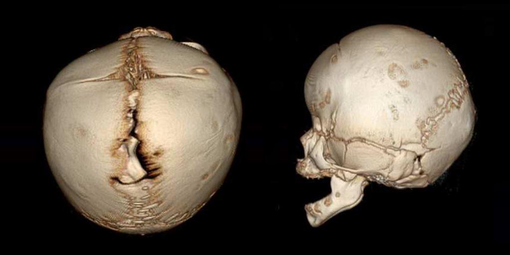 ilateral coronal craniosynostosis, the most common syndromic form, causes a short and wide head.