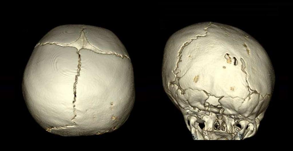 Metopic craniosynostosis causes a triangular shape to the forehead when viewed from above. Eyes may be abnormally close together.