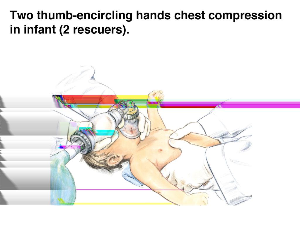 Figure 3: Two thumb-encircling hands chest compression in infant (2 rescuers) 6.