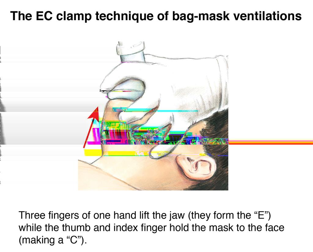 Figure 4: The EC clamp technique of bag-mask ventilations. 6.10.