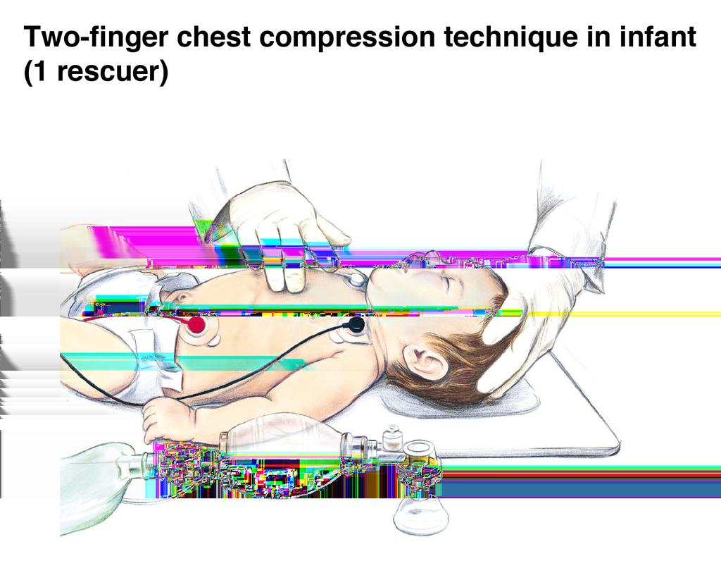 23 Figure 5: Two-finger chest compression technique in infant (1 rescuer) For a child, lay rescuers and healthcare providers should compress the lower half of the sternum at least one third of the AP