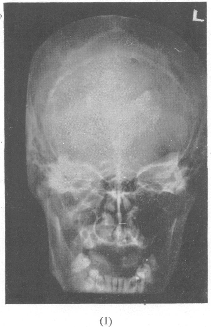 ELECTRO-ENCEPHALOGRAPHY IN CASES OF SUB-CORTICAL TUMOUR 61 by a smaller amount of 2-3 c/s. activity. In Fig. 8 are the X-rays showing a calcified mass below the left fronto-parietal region.
