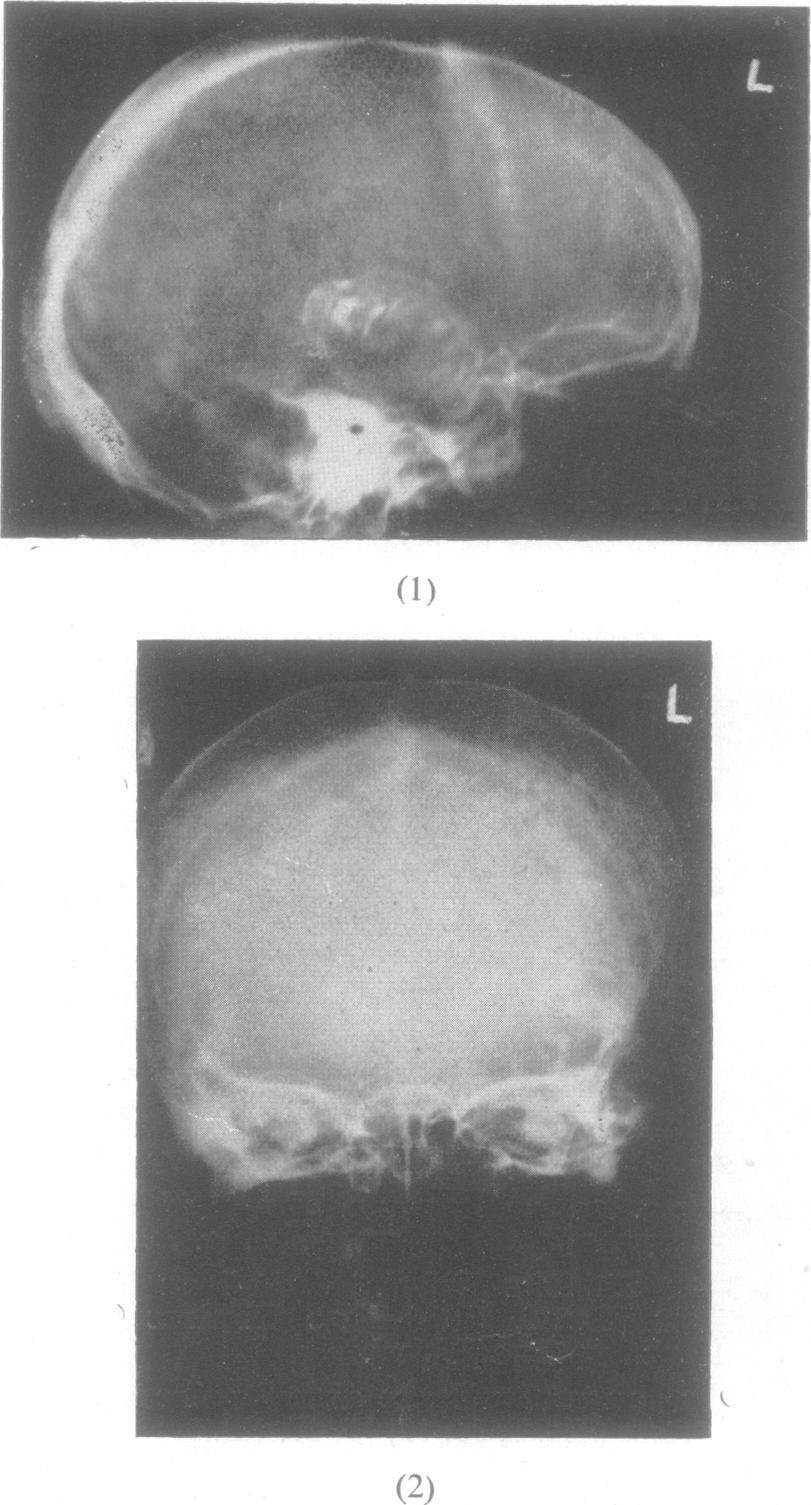 62 W. GREY WALTER AND V. J. DOVEY e.e.g. topograms are shown in Fig. 9 and 10. Fig. 2B is from a patient who has had epileptic attacks and headaches for 20 years.